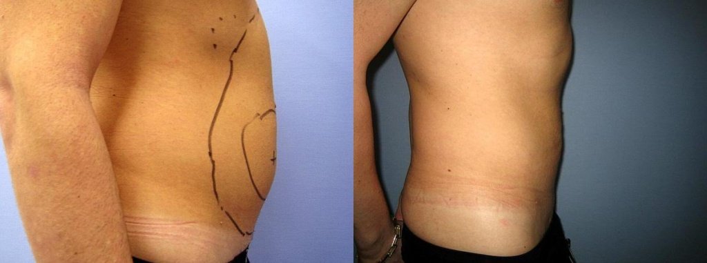liposakciya-zhivota-u-muzhchin.jpg liposakciya-zhivota-u-muzhchin.jpg