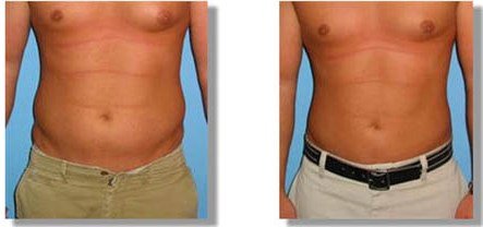 Как похудеть мужчине – Способы похудения для мужчин — Центр эстетической медицины SlimClinic